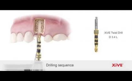 XiVE,implant placement