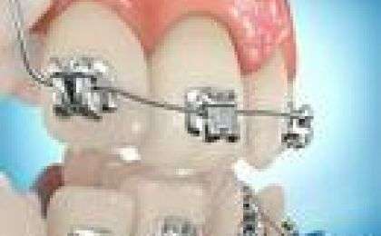 damon,orthodontic,bracket,self,ligating,ligation,computer,graphic,dolphin,aquarium,imaging,ormco,sybron,www.dolphinimaging.com